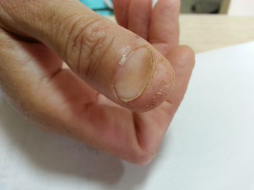 Demir ve Folik Asit Eksikliği Belirtileri ve Tedavisi