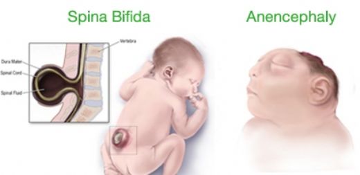 Gebelikte Folik Asit Eksikliği Belirtileri ve Tedavisi